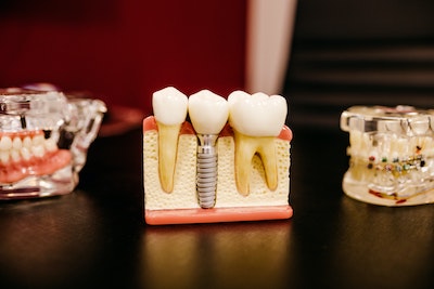 Various dental models showing teeth, gums and dental implants.
